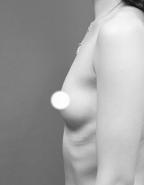 群英整形水滴形果凍隆乳前