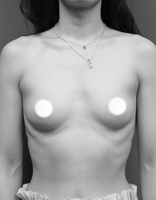 群英整形水滴形果凍隆乳前