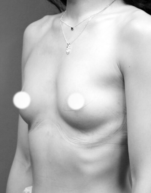 水滴形果凍隆乳前