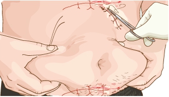 腹部拉皮