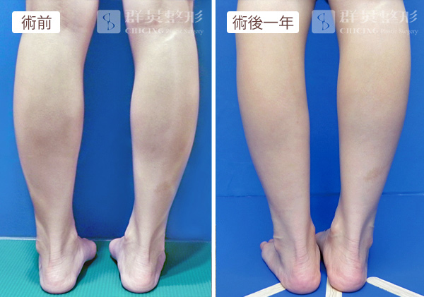 陳廣得醫師_小腿神經截斷術案例