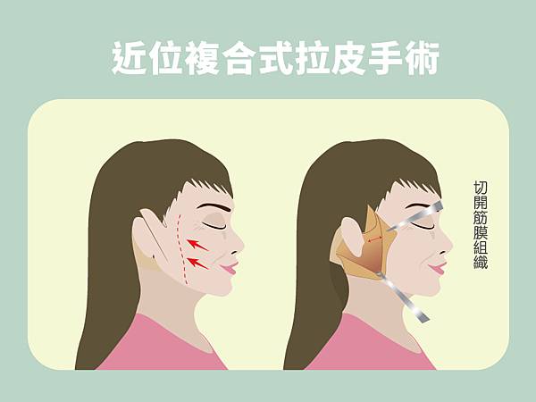 群英林雍球醫師_拉皮文章102109