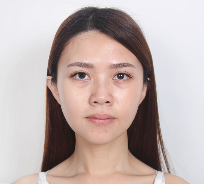 群英整形_眼袋淚溝