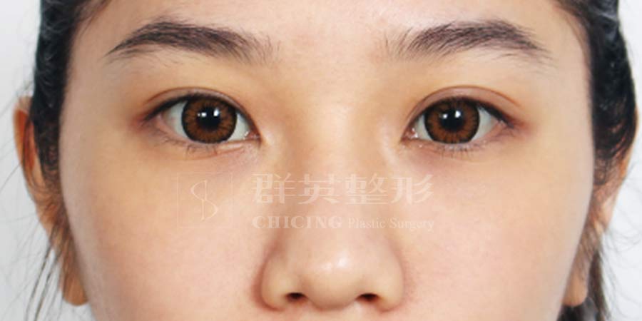 Before-01