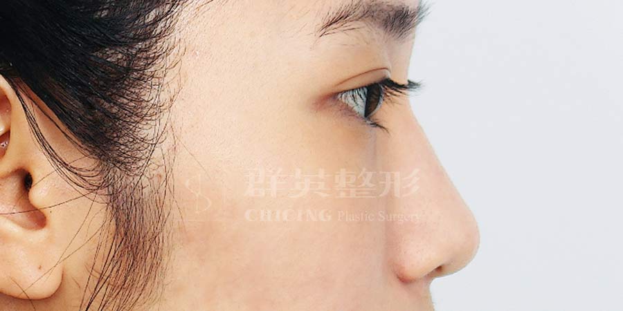 Before-03
