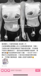 陳廣得醫師_魔滴隆乳案例
