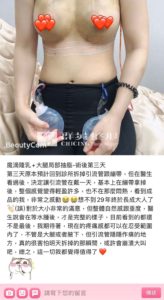 陳廣得醫師_魔滴隆乳案例