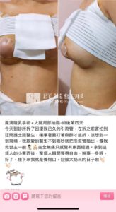 陳廣得醫師_魔滴隆乳案例