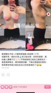 陳廣得醫師_魔滴隆乳案例