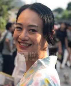 蘇瑋智醫師_眼袋手術案例