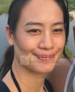 蘇瑋智醫師_眼袋手術案例
