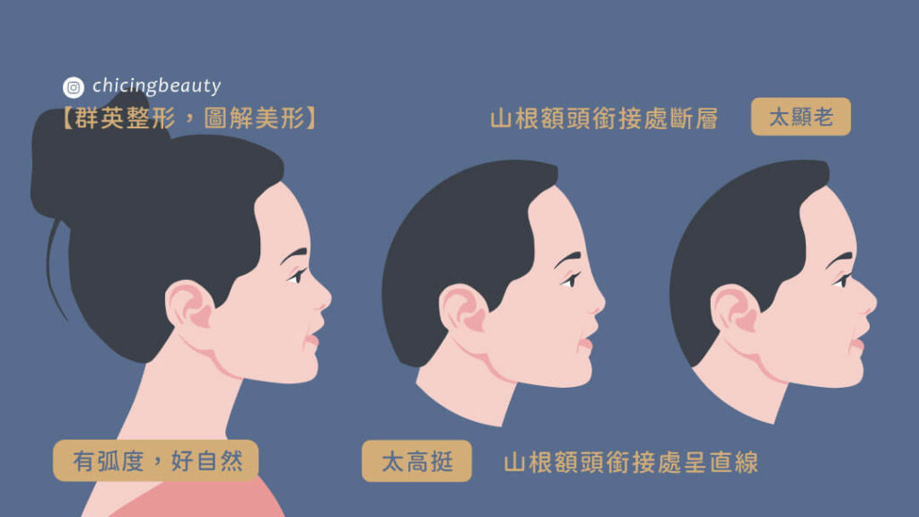 renhoplasty_redo_m01_chicingbeauty_sophiecheng1090630