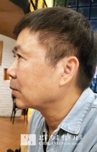 楊沂勳醫師_微創拉皮案例