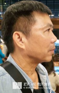 楊沂勳醫師_微創拉皮案例
