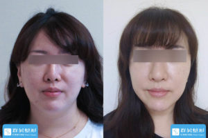 高雄群英_蘇毓彬醫師_雙下巴抽脂33