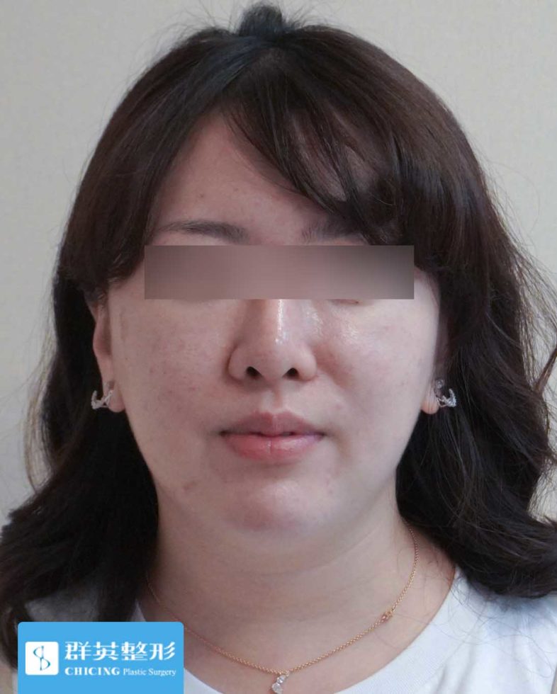 高雄群英_蘇毓彬醫師_雙下巴抽脂15