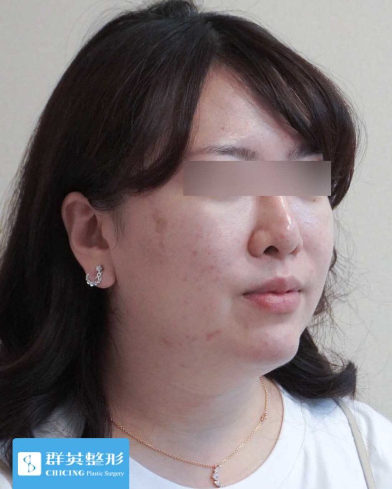 高雄群英_蘇毓彬醫師_雙下巴抽脂14