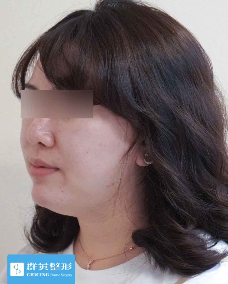 高雄群英_蘇毓彬醫師_雙下巴抽脂12