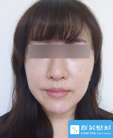 高雄群英_蘇毓彬醫師_雙下巴抽脂04