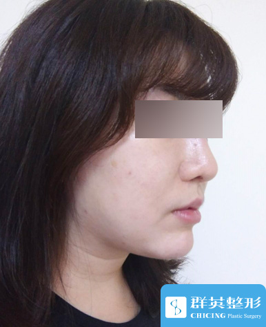 高雄群英_蘇毓彬醫師_雙下巴抽脂02