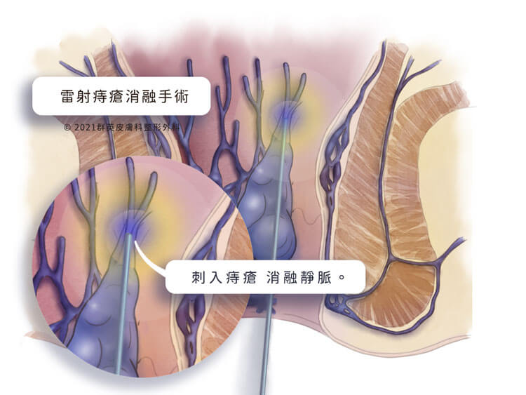 雷射痔瘡消融手術_微創痔瘡手術_痔瘡女醫師_黃郁純醫師