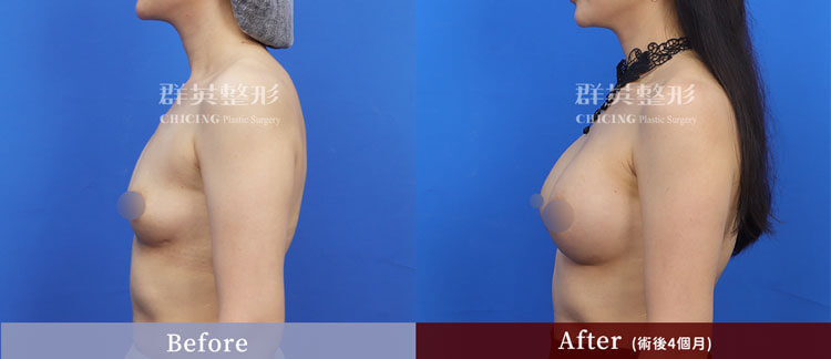台中群英 陳大正醫師 柔滴隆乳 隆乳案例