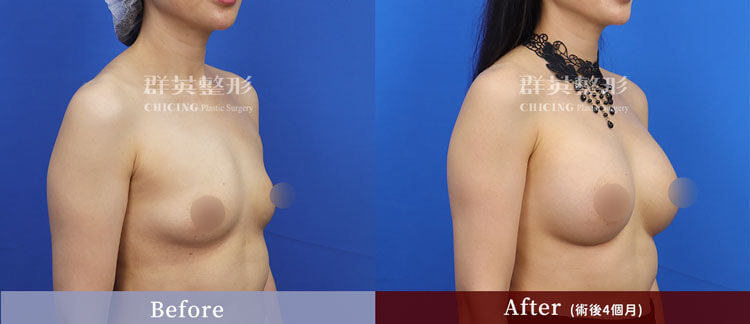 台中群英 陳大正醫師 柔滴隆乳 隆乳案例