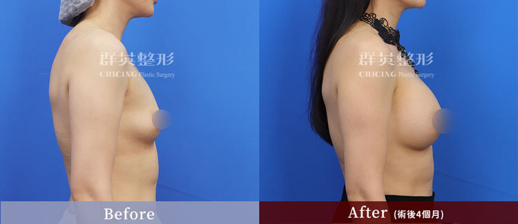 台中群英 陳大正醫師 柔滴隆乳 隆乳案例